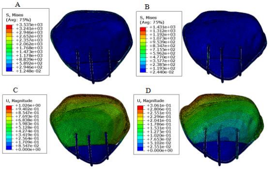 改良前后独立垂直钢丝内固定模型的